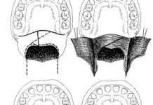 The value of the palatopharyngeal closure in the formation of nasal and oral, vowel and consonant sounds